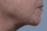Droopy chin repair