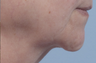 Droopy chin repair