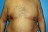 Gynecomastia procedure