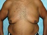 Gynecomastia procedure