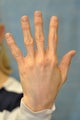 56 Year Old Female Treated for Unacceptable Cosmetic Appearance of Hands