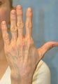 56 Year Old Female Treated for Unacceptable Cosmetic Appearance of Hands
