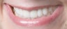 Porcelain Crowns and Porcelain Veneers
