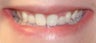 Porcelain Crowns and Porcelain Veneers