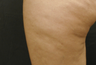 Cellulaze - Cellulite Treatment
