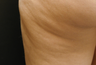 Cellulaze - Cellulite Treatment