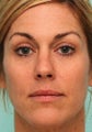MicroLaser Peel / Laser Resurfacing and IPL