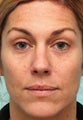 MicroLaser Peel / Laser Resurfacing and IPL