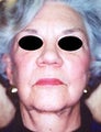 Female patient who underwent liposuction