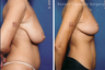 Breast lift (no implants) with nipple reduction