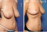 Breast lift (no implants) with nipple reduction