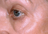 Erbium Laser Resurfacing