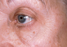 Erbium Laser Resurfacing