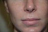 Before and Two Weeks After Upper Lip Lift