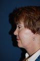 Female with Eyelid Surgery