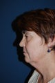 Female with Eyelid Surgery