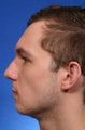 Chin implant combined with rhinoplasty