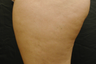 Cellulite Treatment - Cellulaze