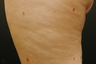 Cellulite Treatment - Cellulaze