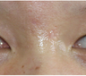 Facial Scar Removal/Treatment