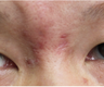 Facial Scar Removal/Treatment