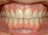 Upper crowded teeth and narrow smile
