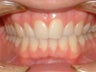 Upper crowded teeth and narrow smile