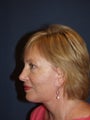 56 Year Old Woman with Eyelid Surgery, Facelift, Brow Lift and Facial Implants