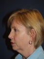 56 Year Old Woman with Eyelid Surgery, Facelift, Brow Lift and Facial Implants