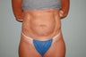 Abdominoplasty