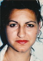 22 year old lady before and after otoplasty (ear surgery)
