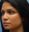 Cheek Dermafillers,Facial Dermafillers,Cheek Enhancement,Eye Dermafillers