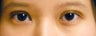 blepharoplasty