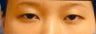 blepharoplasty