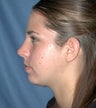 Chin Augmentation