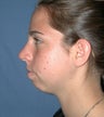 Chin Augmentation