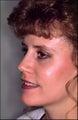 rhinoplasty