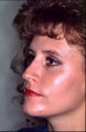 rhinoplasty