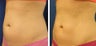 CoolSculpting Treatment Before and After