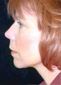 Quicklift w/neck liposuction