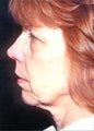 Quicklift w/neck liposuction