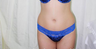 This 27 years feamle underwent liposucupture to her butt and tummy 6 months post oeperative results are seen