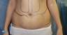 This 27 years feamle underwent liposucupture to her butt and tummy 6 months post oeperative results are seen