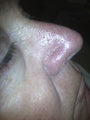 66 yo male with nasal veins