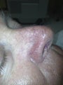 66 yo male with nasal veins