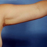 Arm Liposuction