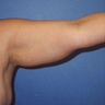Arm Liposuction