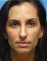 Eye Dermafillers,Cheek Dermafillers,Facial Dermafillers