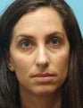 Eye Dermafillers,Cheek Dermafillers,Facial Dermafillers