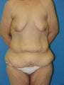 40 yr old woman for body lift